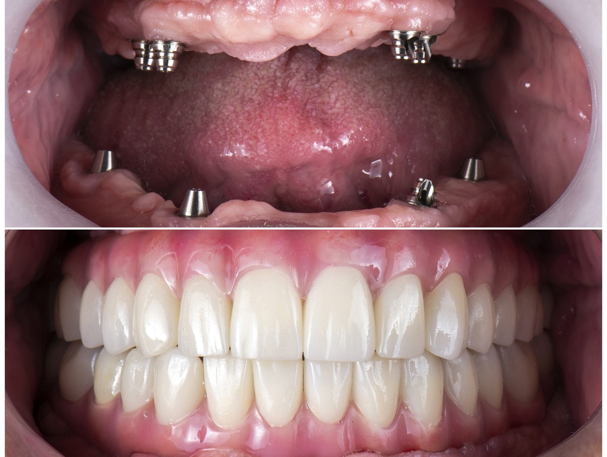 Clinical example — full mouth implant rehabilitation