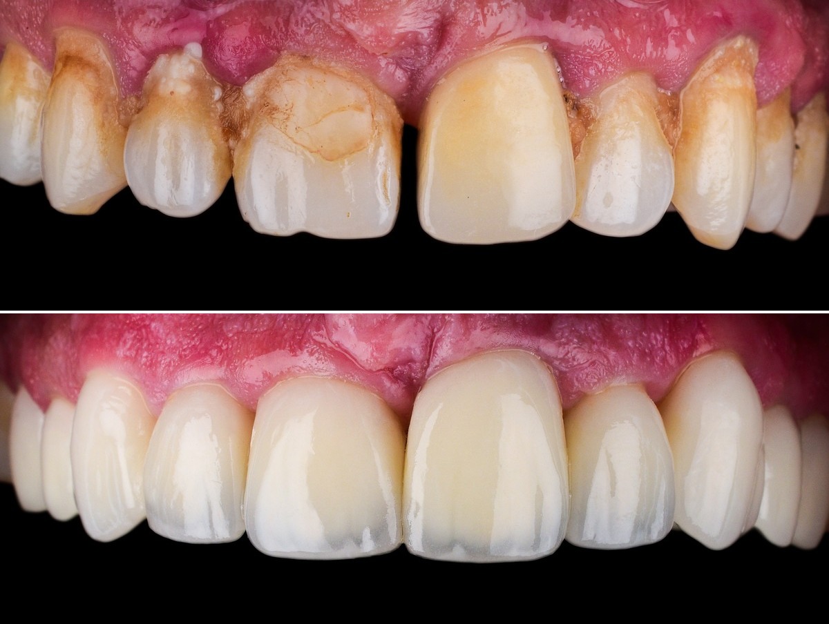 Clinical example — full mouth makeover with crowns