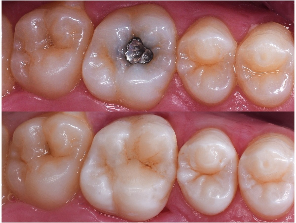 Clinical example — amalgam filling replacement