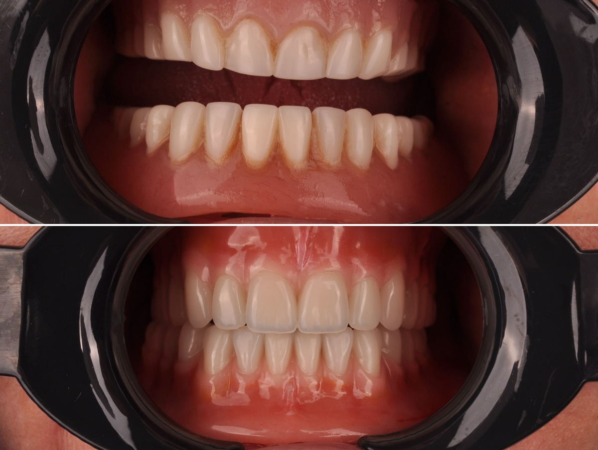 Clinical example — bespoke dentures