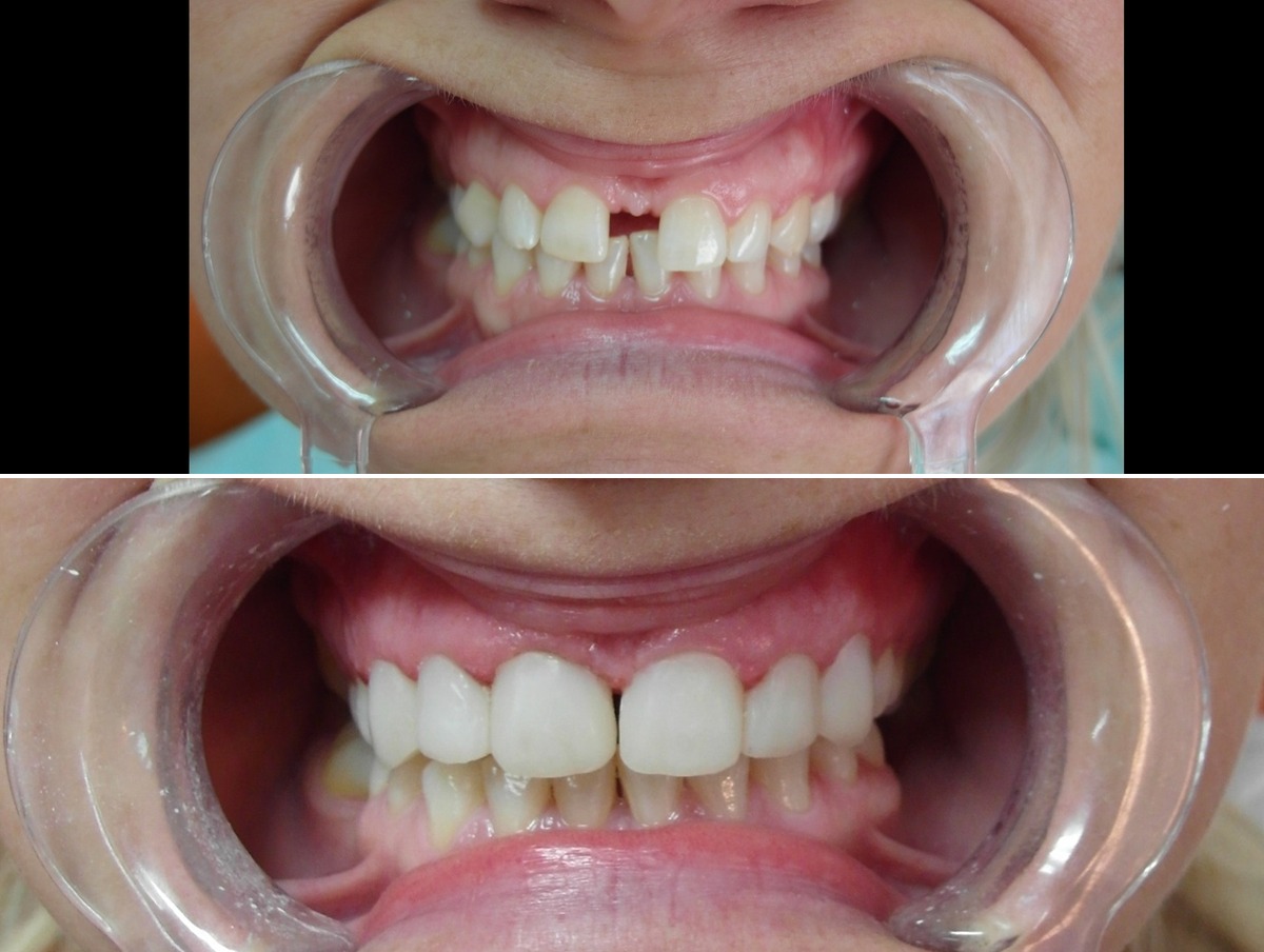 Clinical example — gap closure with implant