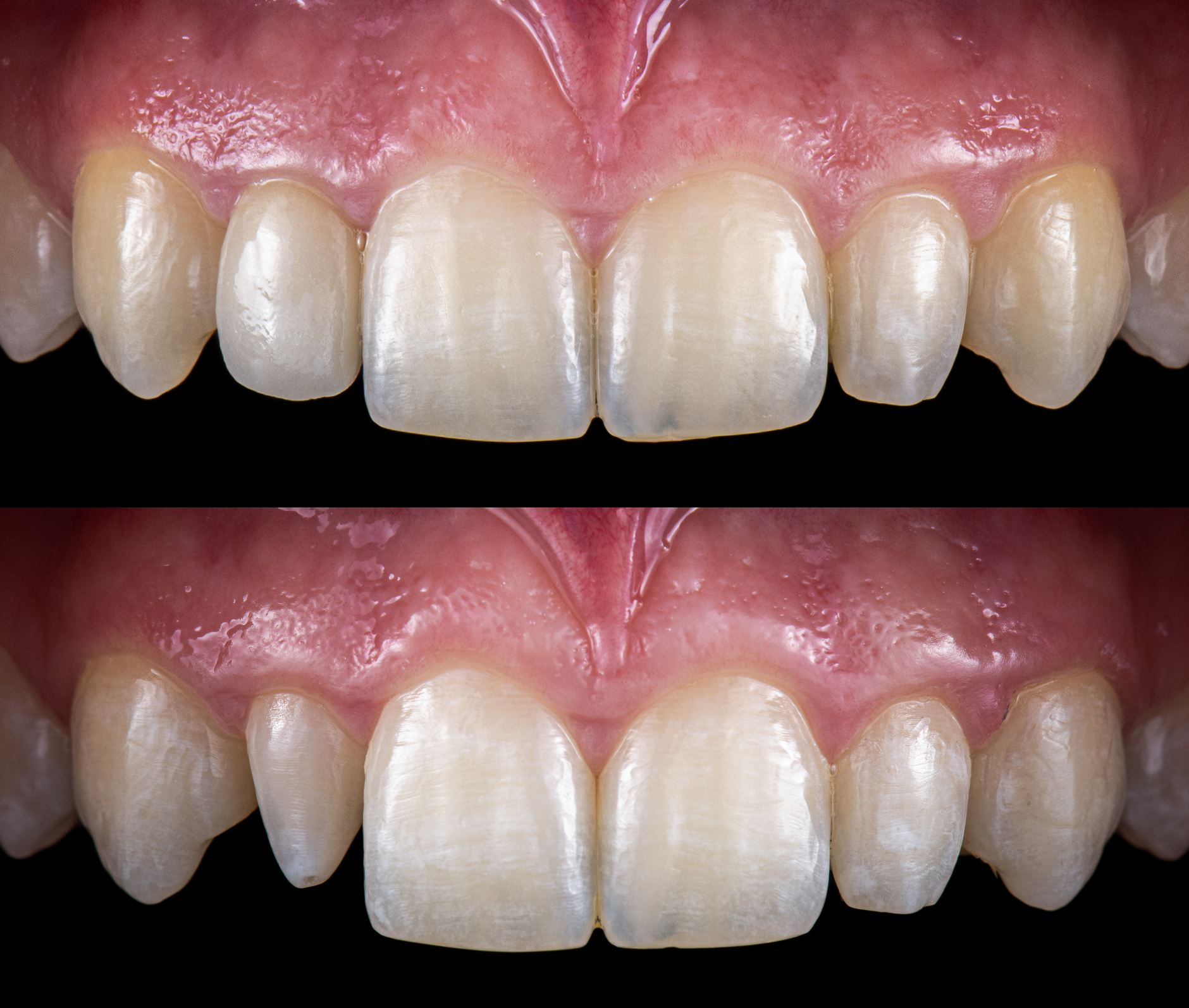 Composite Bonding